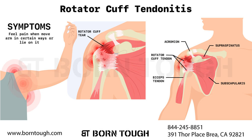 Rotator Cuff Tendonitis